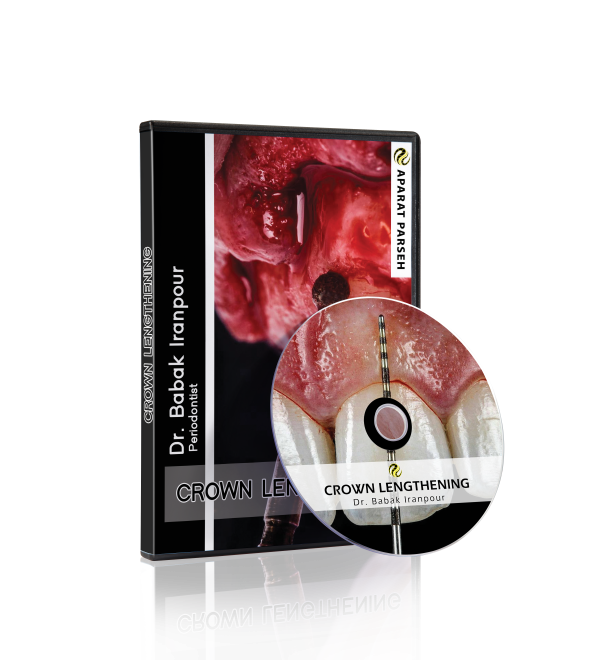 Crown Lengthening