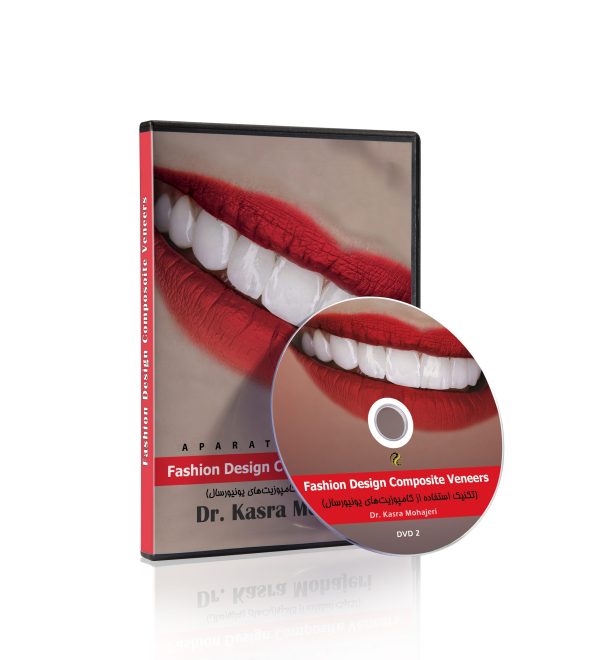 Fashion Design Composite Veneers (تکنیک استفاده از کامپوزیت‌های یونیورسال)